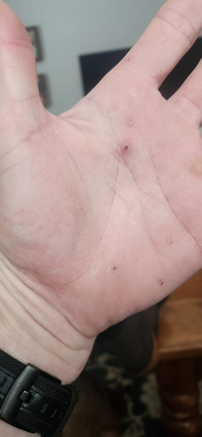 Customer photo review of The Wartabater | Electronic Wart Remover | Safe, Easy, & Effective