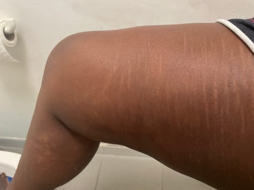 Customer photo review of Huile de vergetures apaisante à base de lavande