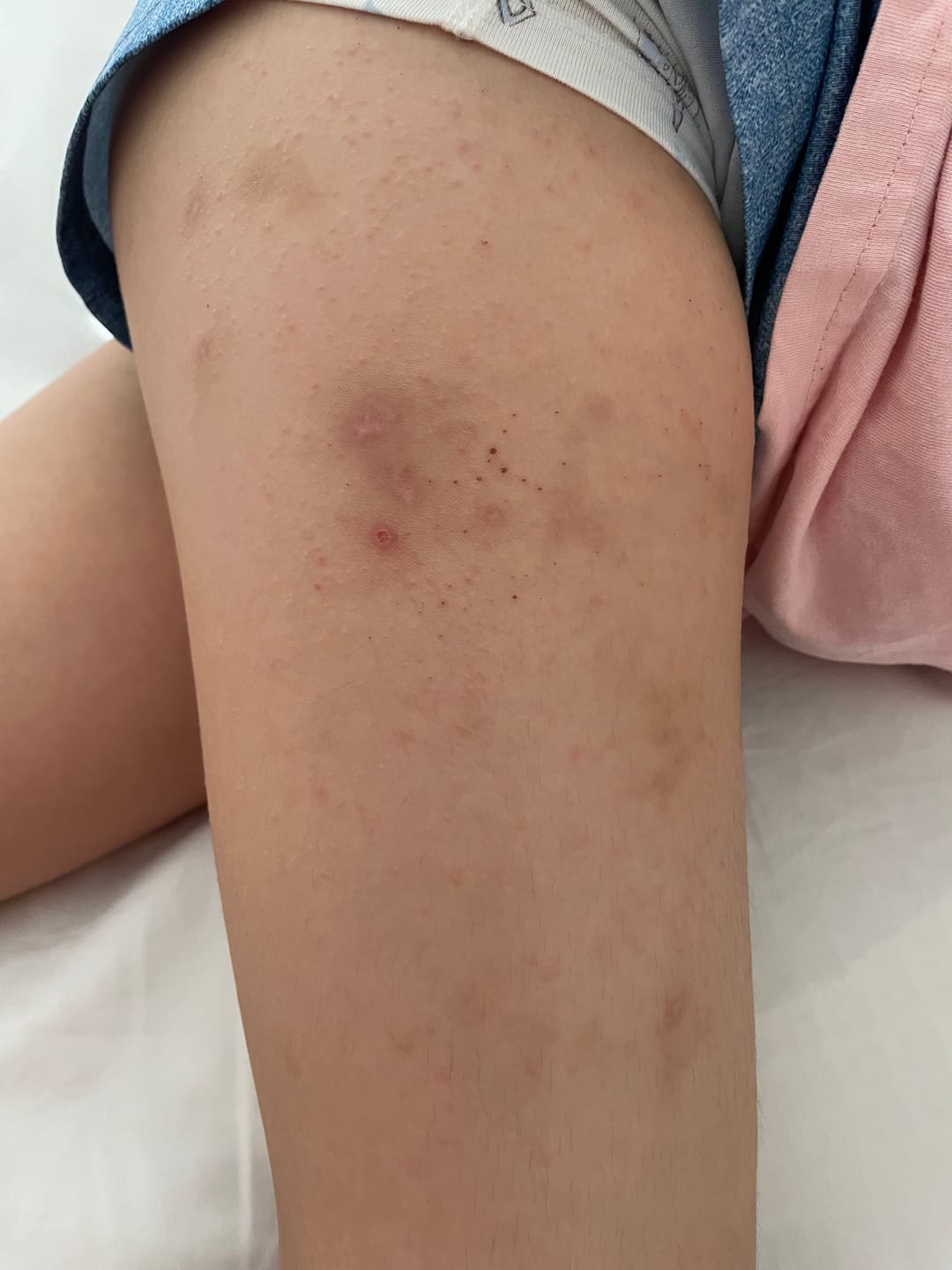 Customer photo review of DermaGen Skin Recovery Lotion