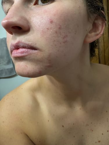 Customer photo review of BeautyPro 2.0 High Frequency Wand