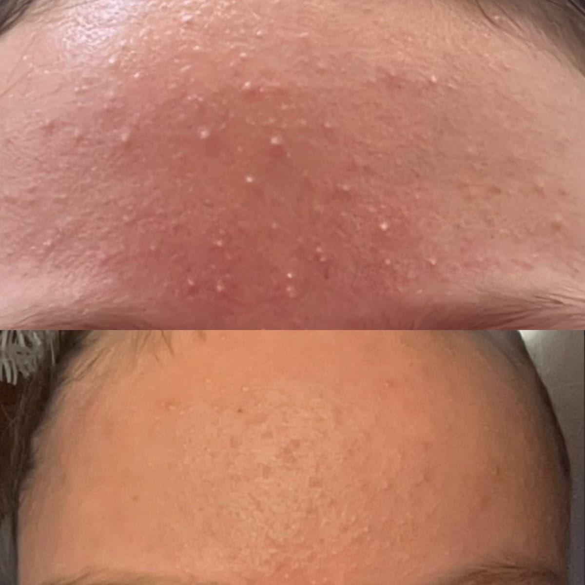 Customer photo review of Porenfeines 4% BHA PEELING