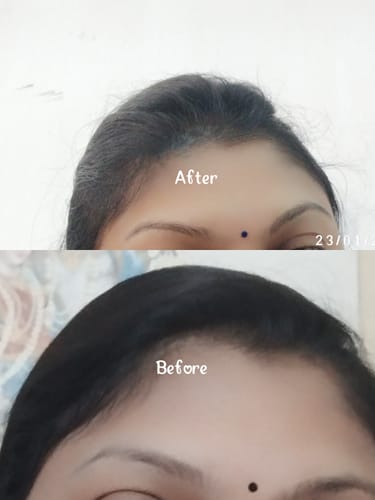 Customer photo review of INVISIBLE COVER-UP PATCH