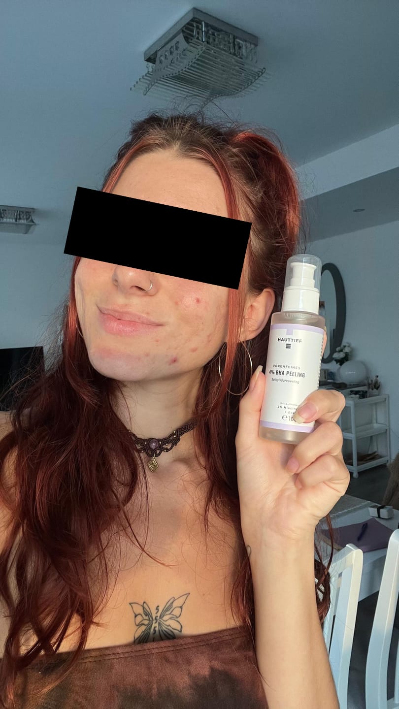 Customer photo review of Porenfeines 4% BHA PEELING