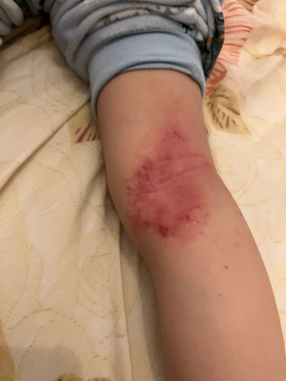 Customer photo review of Large Bioskin Junior Duo Pack