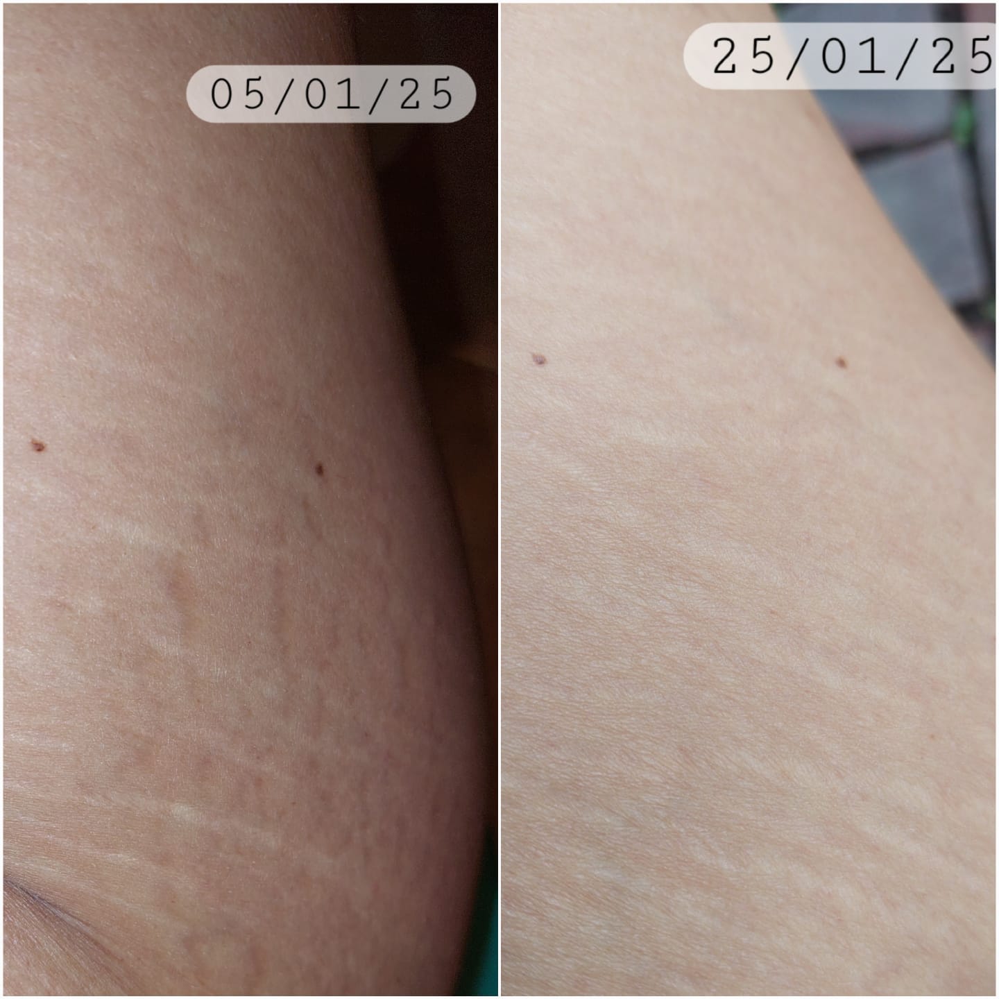 Customer photo review of Crema AntiEstrías🧴🦵 - 200ml EMILY