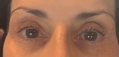 Customer photo review of Under Eye Skincare Wand