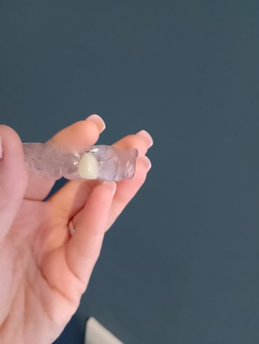 Customer photo review of Missing Tooth Retainer, Instant Smile Fix