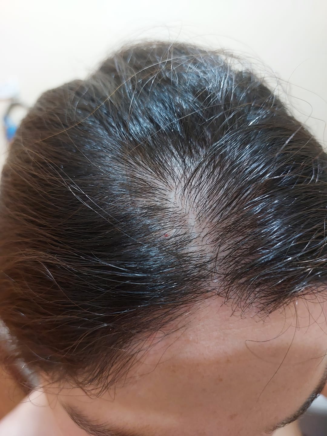 Customer photo review of Pack Anticaída de Cabello para 1 Mes