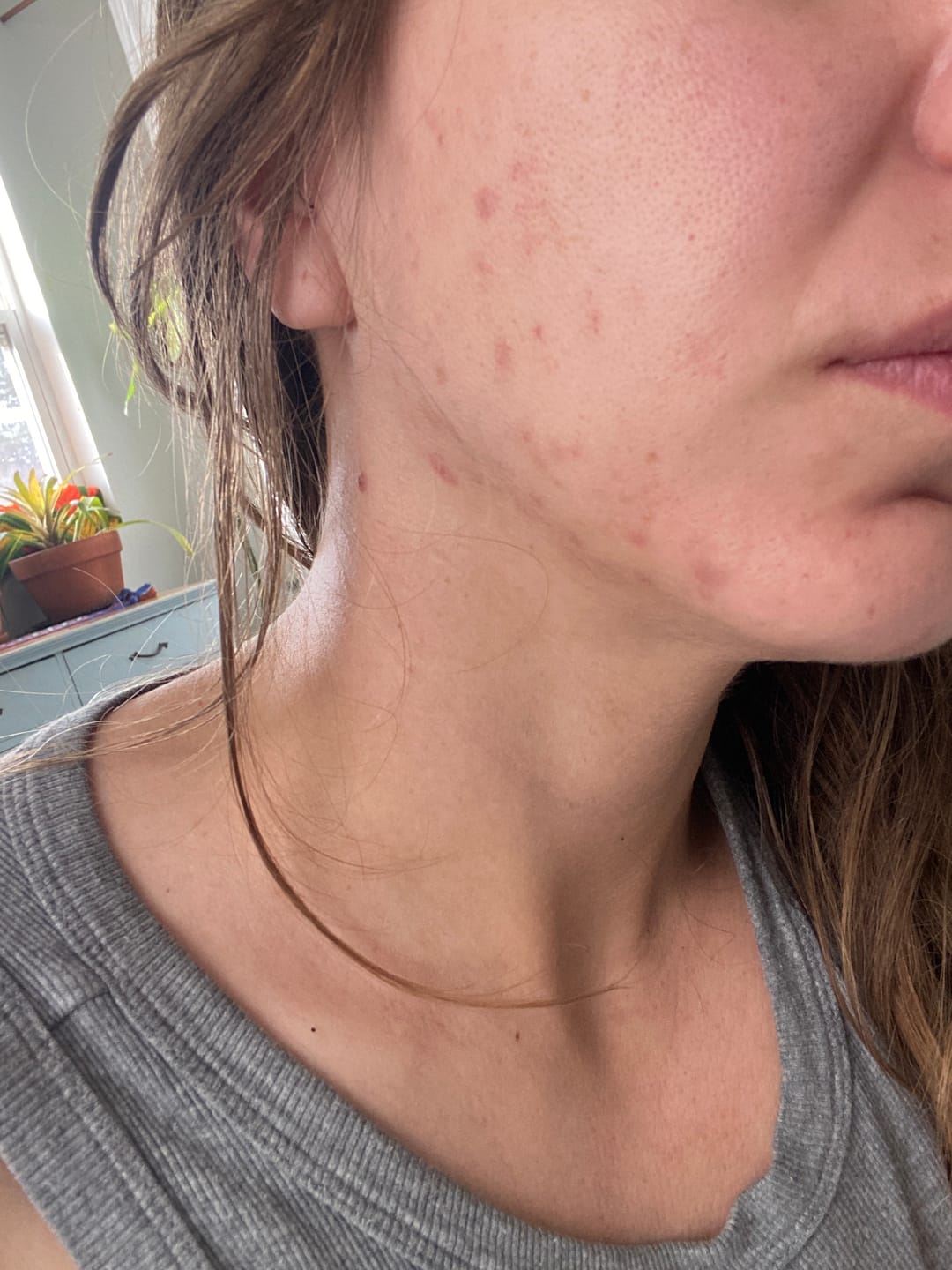 Customer photo review of Vegan PCOS Skin Health Supplement Bundle - Bundle & Save