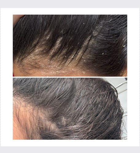 Customer photo review of מרכך מרוכז להזנת השיער - 3 יחידות | SCALP CONTROL