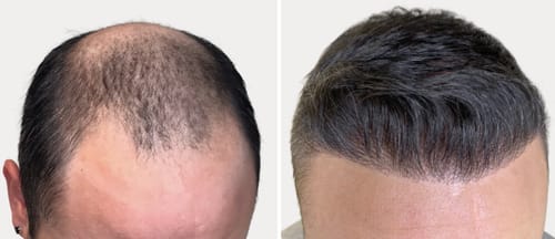 Customer photo review of HairForce™ LED-Therapie Kappe gegen Haarausfall