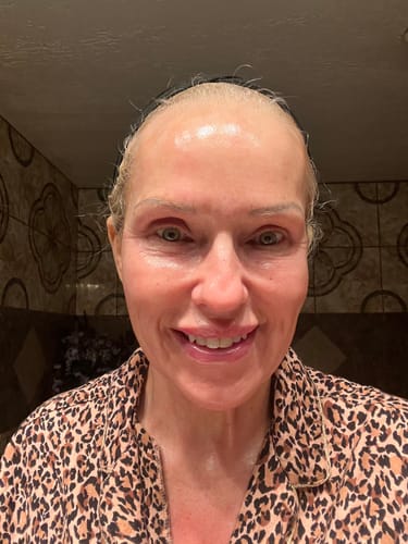 Customer photo review of Radiant Glow Pads (Acid Wipes)