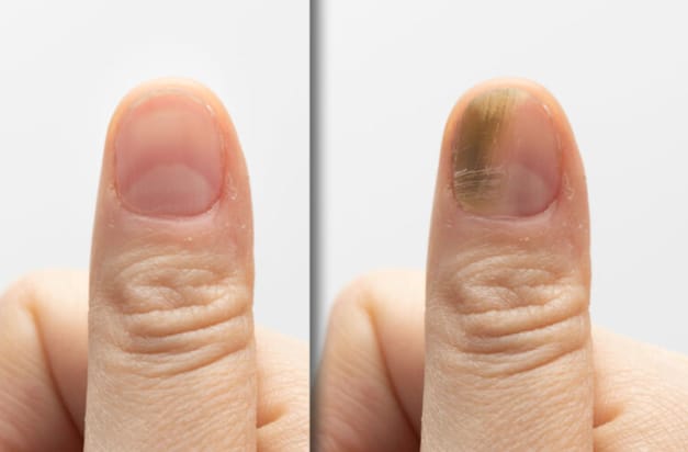 Customer photo review of DermaBlue™ Blaulicht Therapiegerät gegen Nagelpilz