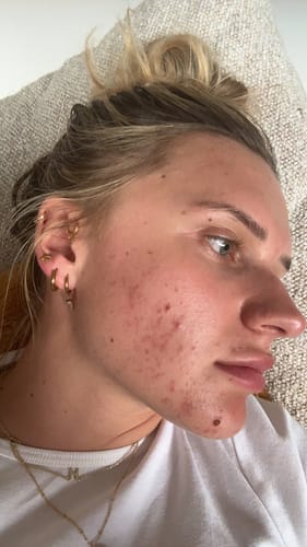 Customer photo review of Intermediate Acne Program™