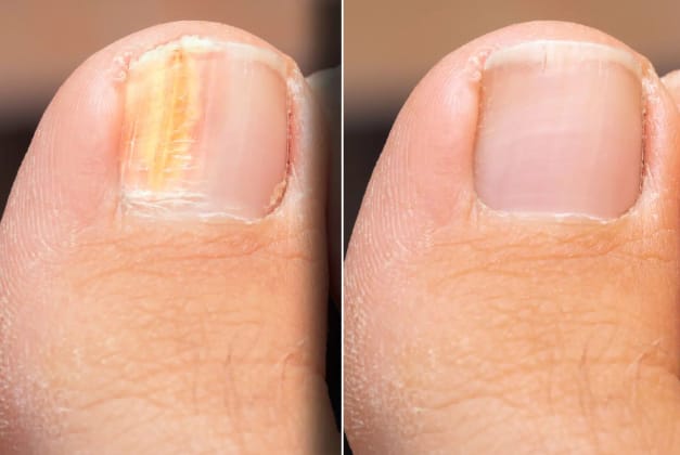 Customer photo review of DermaBlue™ Blaulicht Therapiegerät gegen Nagelpilz