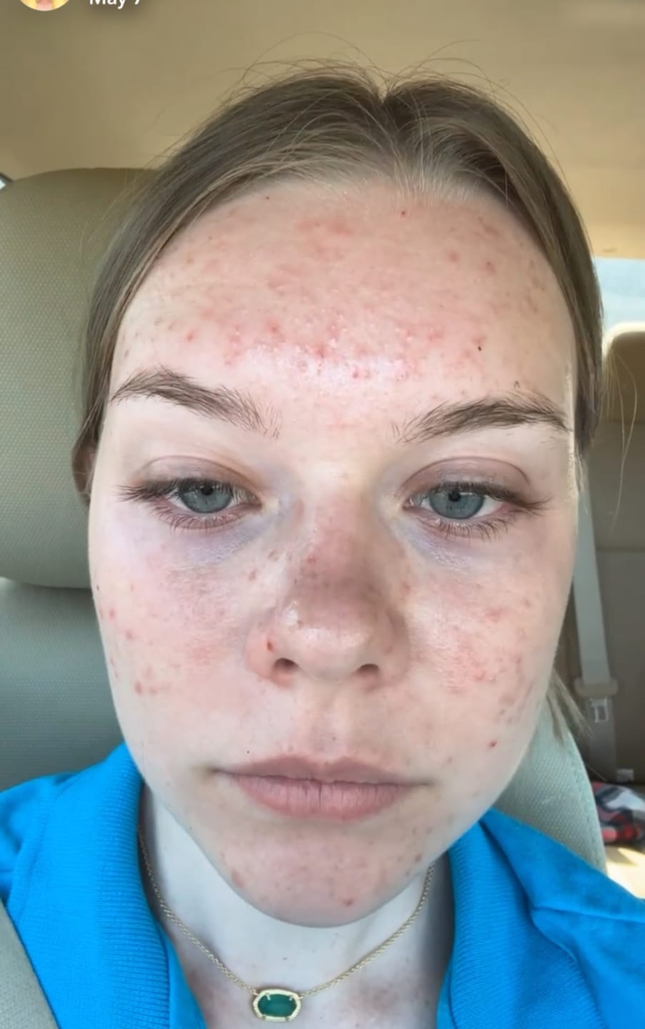 Customer photo review of Acne & Redness Killer