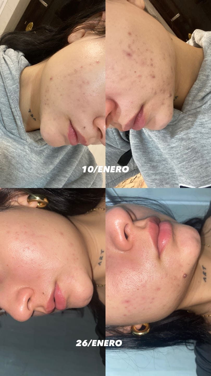 Customer photo review of A CONTROL - ACNÉ HORMONAL & RESISTENCIA A LA INSULINA