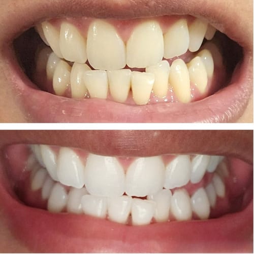 Customer photo review of Polar MD Teeth Whitening Kit