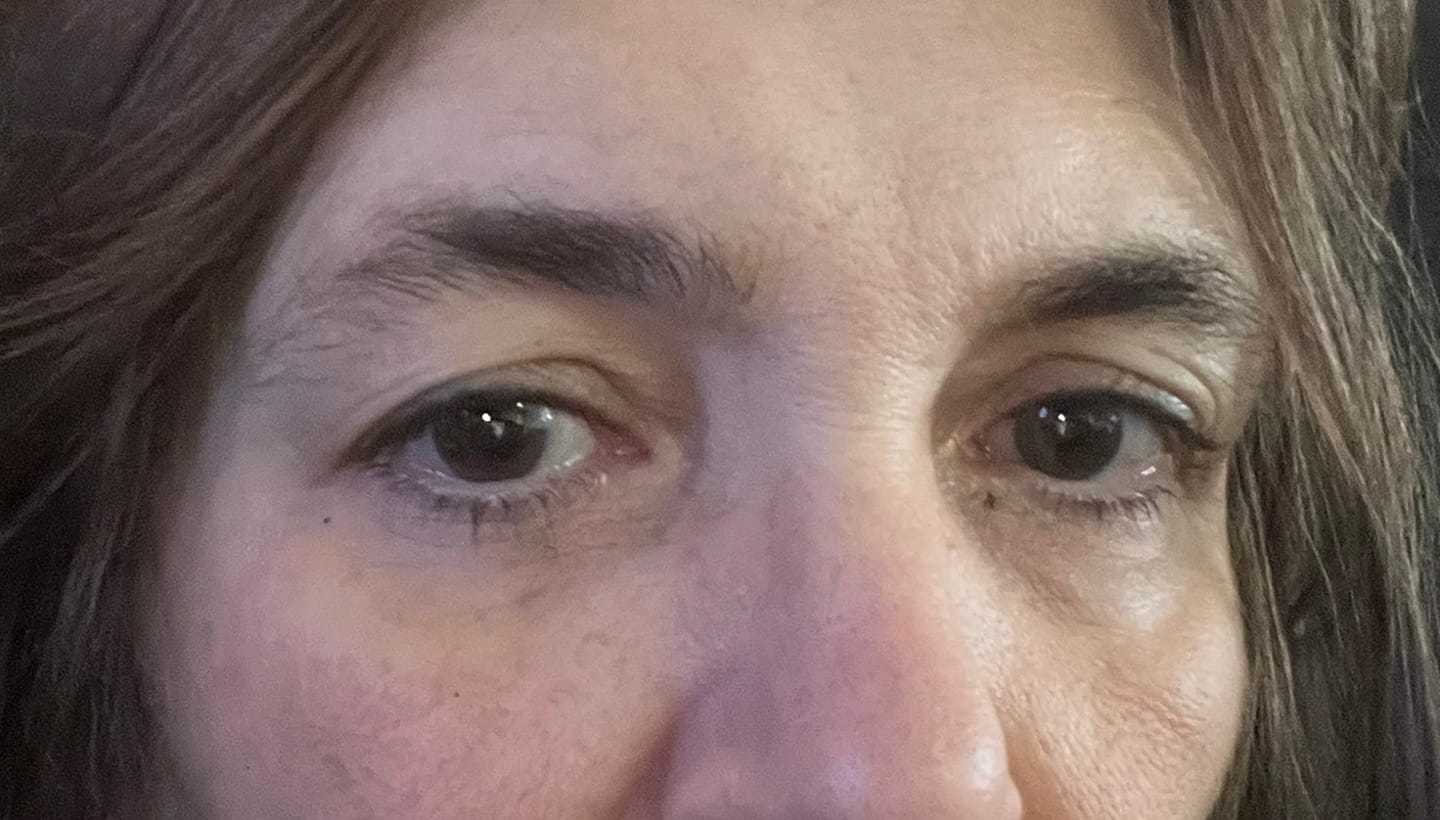 Customer photo review of Micro Infusion Patches