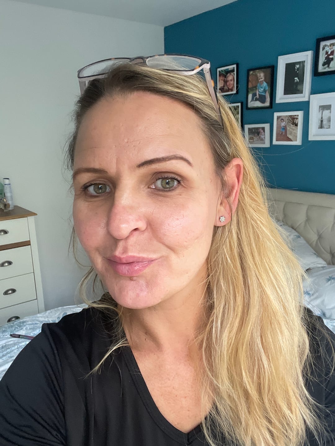 Customer photo review of Micro Infusion Patches