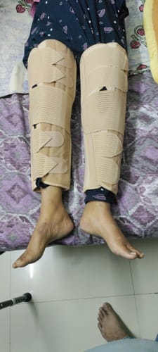 Customer photo review of Knee Brace - Long (19" Brace) | Ideal firm Knee support that limits knee motion & stabilizes the knee with mediolateral metal supports | Color - Beige