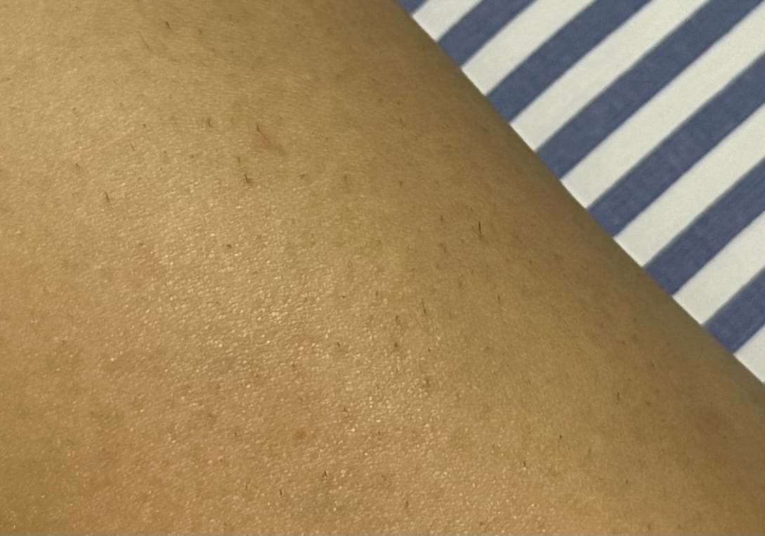 Customer photo review of INIA HAUTE Pro IPL Hair Removal Device