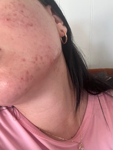 Customer photo review of Starter Acne Program™
