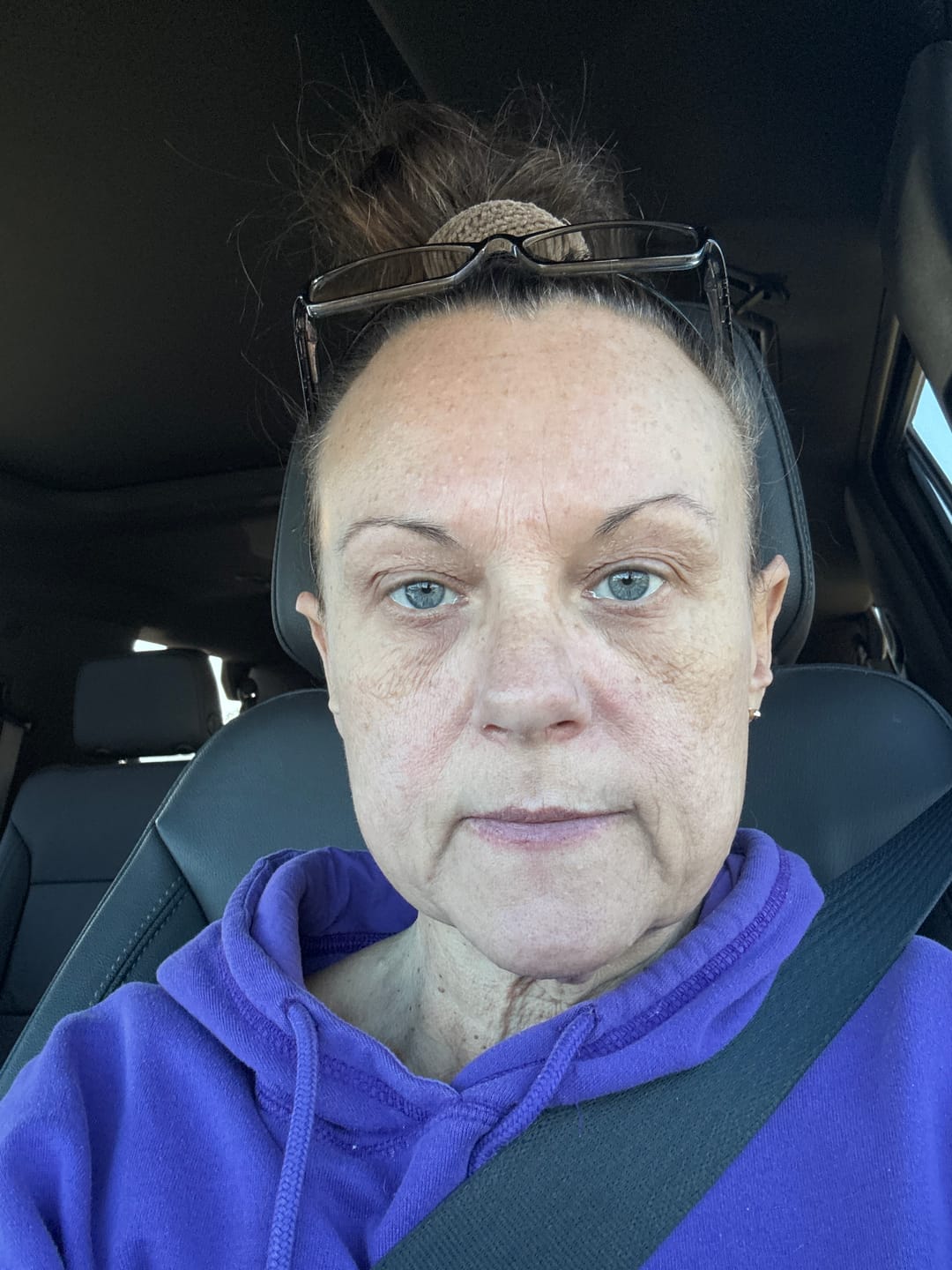 Customer photo review of Anti-Aging treatment