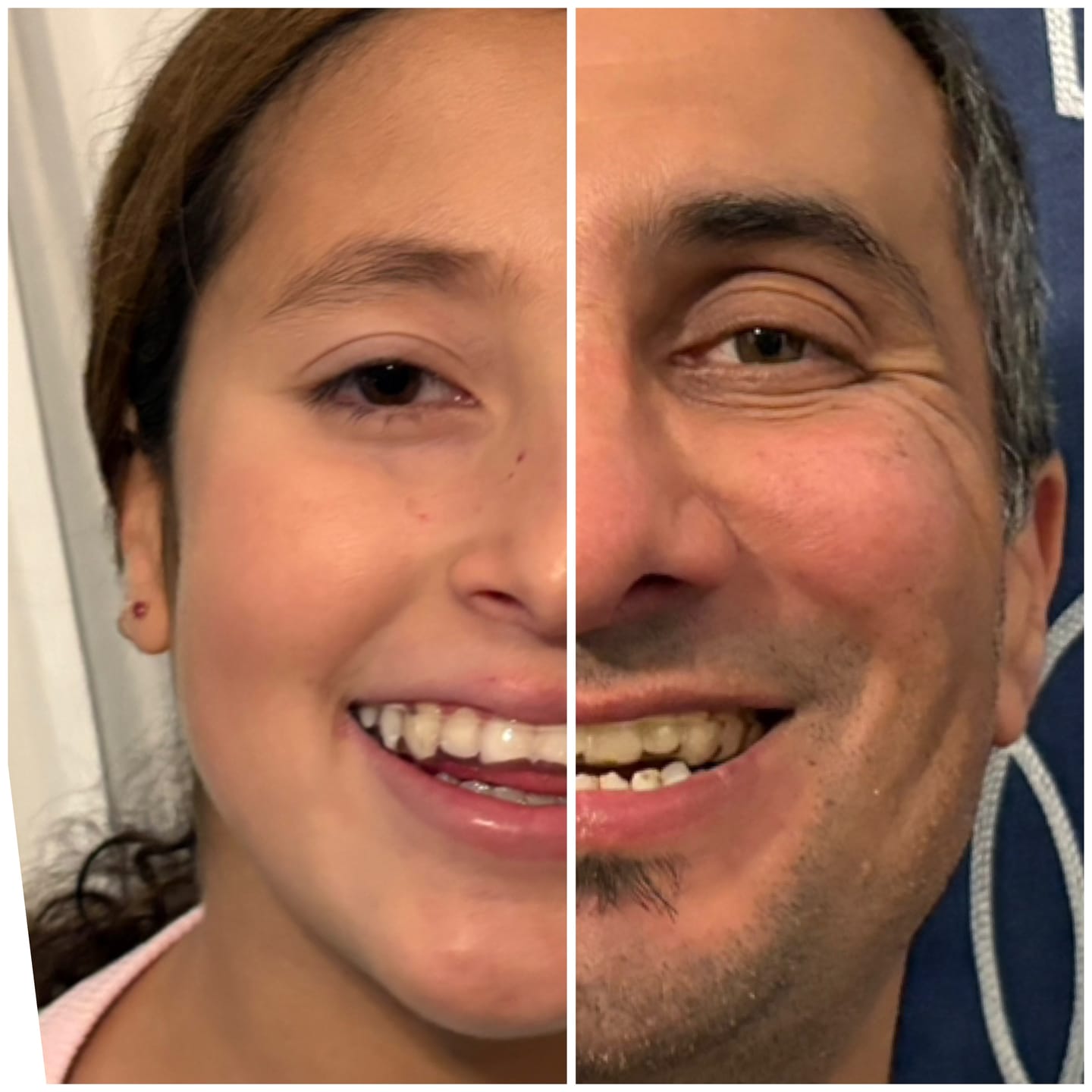 Customer photo review of 3mm Dual-Layer Hybrid Night Guard for Teeth Grinding - Ideal to Protect Veneers, Crowns, Implants