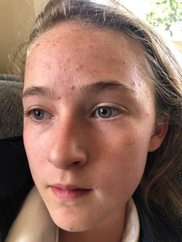 Customer photo review of Intermediate Acne Program™