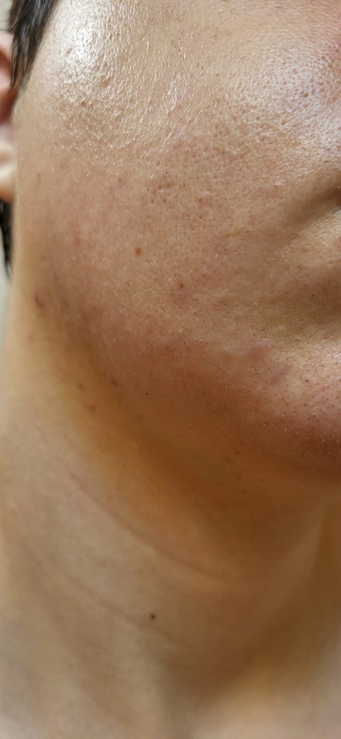 Customer photo review of The Complete Acne System for Women