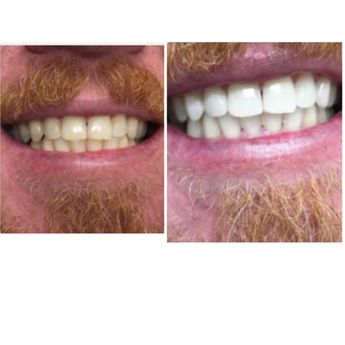 Customer photo review of Polar MD Teeth Whitening Kit