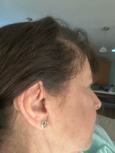 Customer photo review of BTE Rechargeables (Pair Of 2 Hearing Aids)