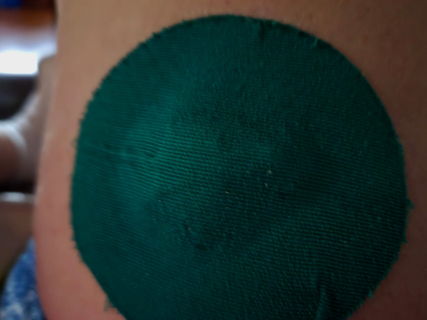 Customer photo review of Skin Grip Original - Medtronic Guardian/Enlite Adhesive Patches