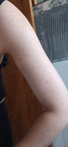 Customer photo review of Bumps Be Gone
