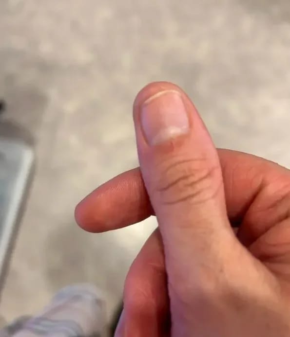 Customer photo review of VELCURA™ Fungal Nail Patches