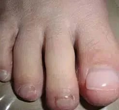 Customer photo review of VELCURA™ Fungal Nail Patches