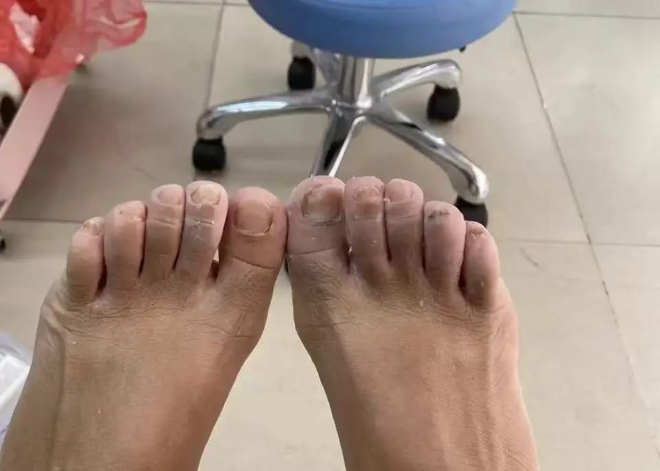 Customer photo review of VELCURA™ Fungal Nail Patches
