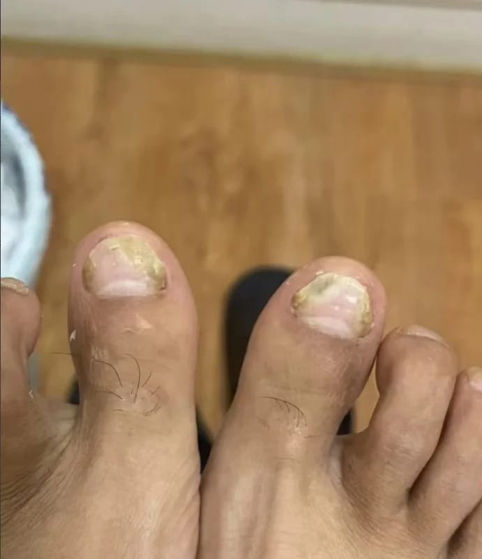 Customer photo review of VELCURA™ Fungal Nail Patches