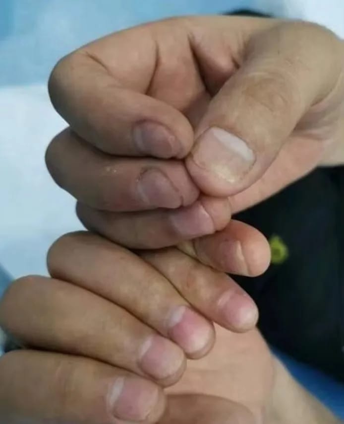 Customer photo review of VELCURA™ Fungal Nail Patches