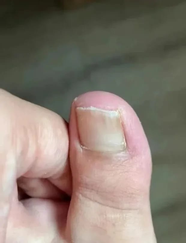 Customer photo review of VELCURA™ Fungal Nail Patches