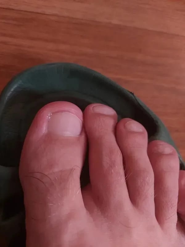 Customer photo review of VELCURA™ Fungal Nail Patches