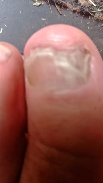 Customer photo review of VELCURA™ Fungal Nail Patches