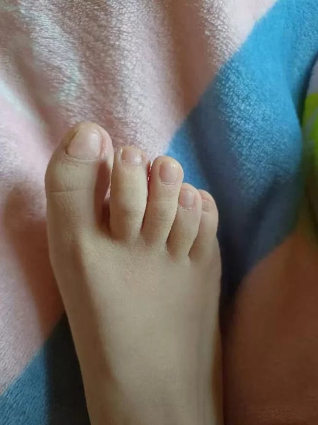 Customer photo review of VELCURA™ Fungal Nail Patches