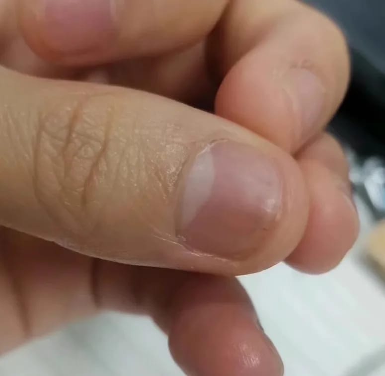 Customer photo review of VELCURA™ Fungal Nail Patches