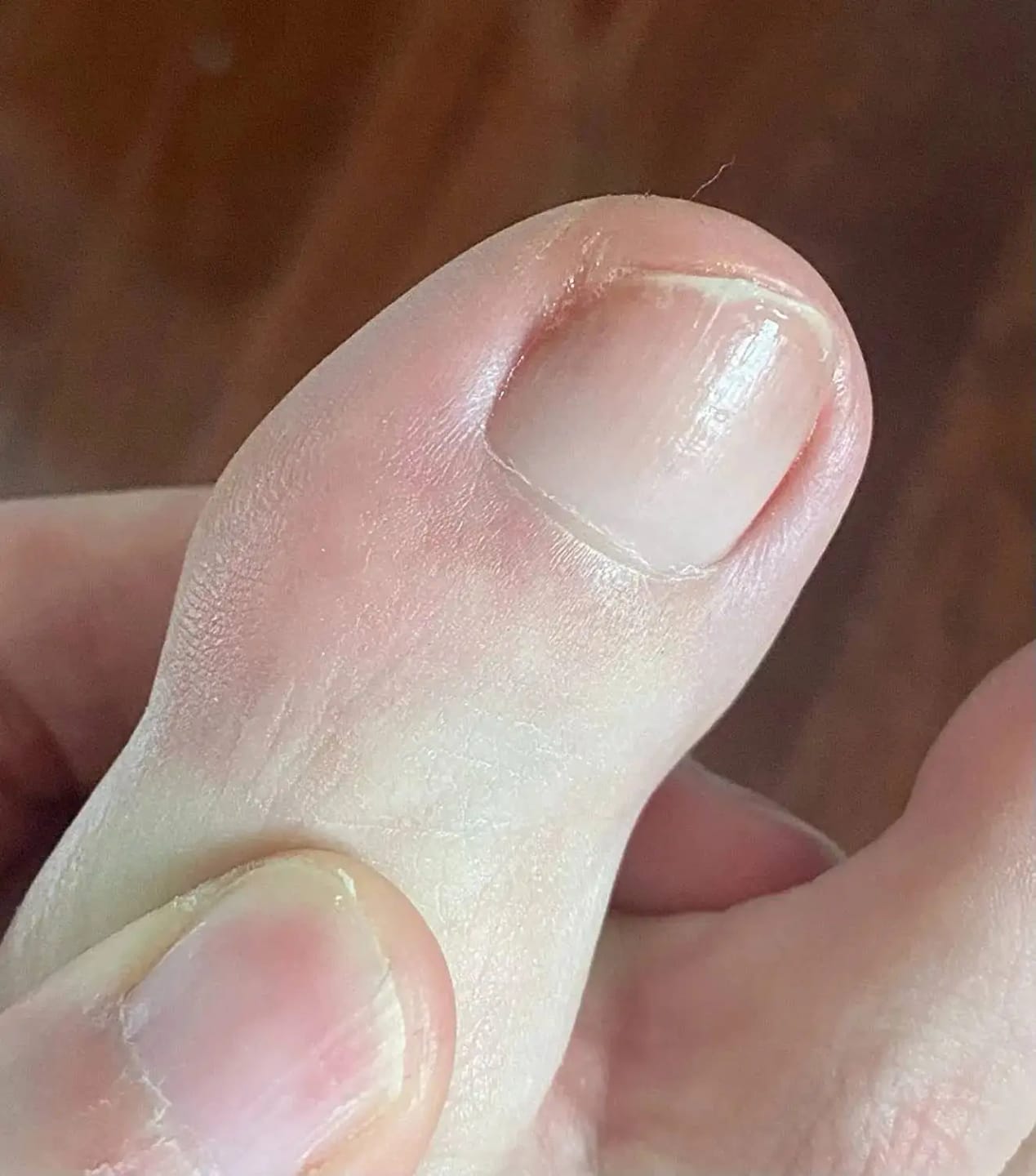 Customer photo review of VELCURA™ Fungal Nail Patches