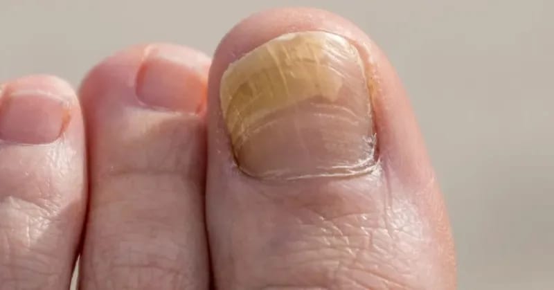 Customer photo review of VELCURA™ Fungal Nail Patches