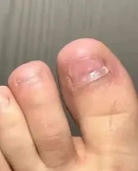 Customer photo review of VELCURA™ Fungal Nail Patches