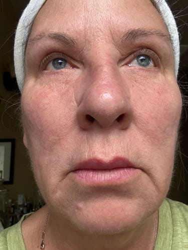 Customer photo review of Glov Micro Infusion System