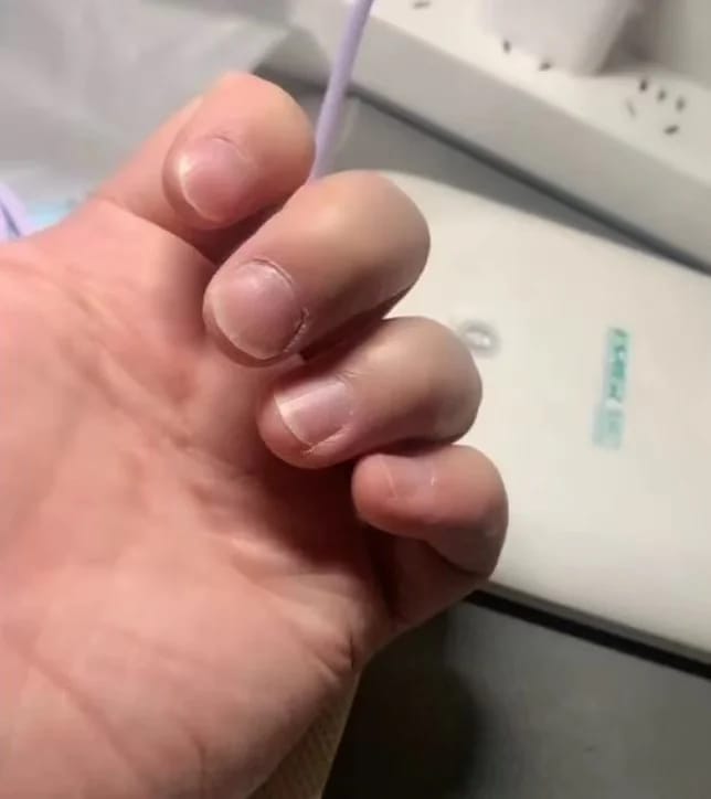 Customer photo review of VELCURA™ Fungal Nail Patches